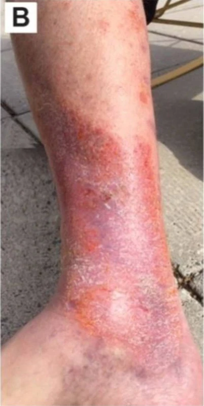 Blickdiagnose-Quiz Fall 14: klinisches Bild – welche Diagnose?