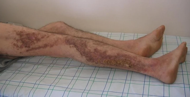 Blickdiagnose-Quiz Fall 50: klinisches Bild – welche Diagnose?