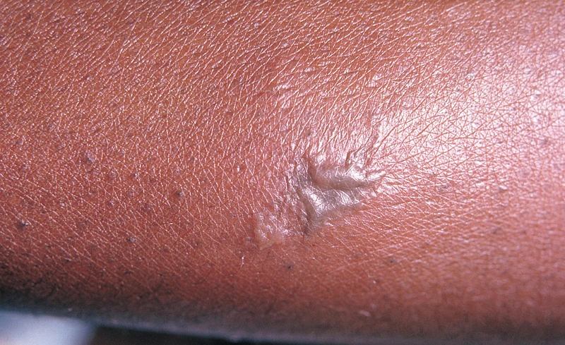Blickdiagnose-Quiz Fall 49: klinisches Bild – welche Diagnose?