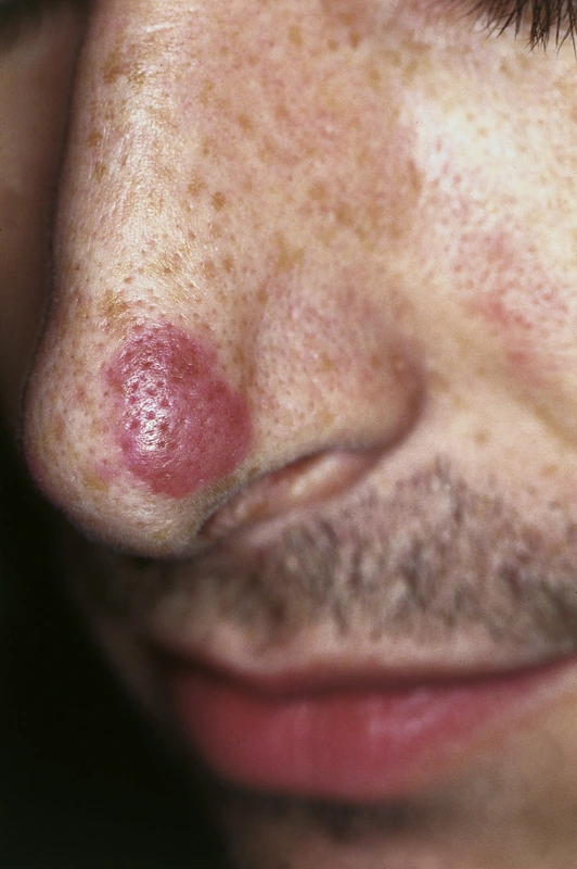 Blickdiagnose-Quiz Fall 52: klinisches Bild – welche Diagnose?