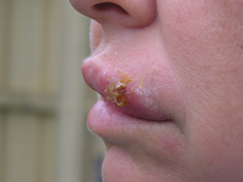Blickdiagnose-Quiz Fall 25: klinisches Bild – welche Diagnose?