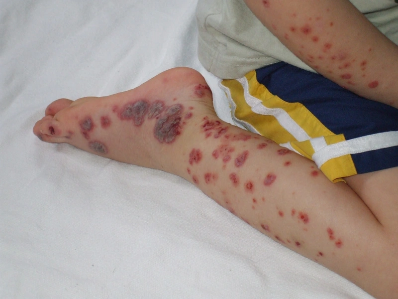 Blickdiagnose-Quiz Fall 53: klinisches Bild – welche Diagnose?