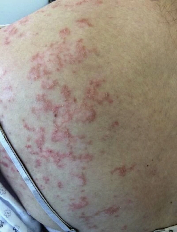Blickdiagnose-Quiz Fall 54: klinisches Bild – welche Diagnose?