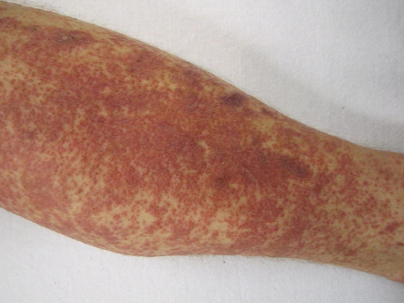 Blickdiagnose-Quiz Fall 33: klinisches Bild – welche Diagnose?