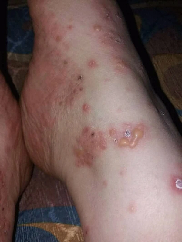 Blickdiagnose-Quiz Fall 55: klinisches Bild – welche Diagnose?