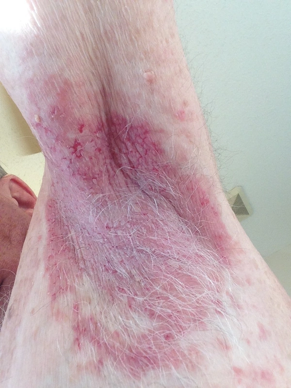 Blickdiagnose-Quiz Fall 35: klinisches Bild – welche Diagnose?