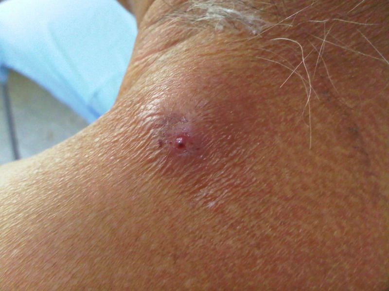 Blickdiagnose-Quiz Fall 34: klinisches Bild – welche Diagnose?