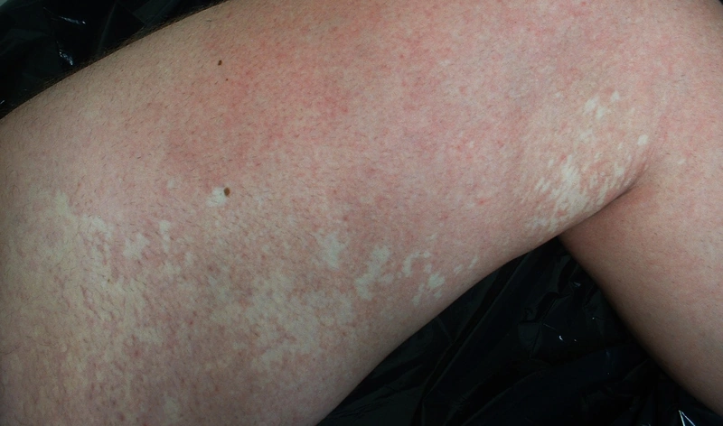 Spot-diagnosis quiz case 30: clinical image – which diagnosis?