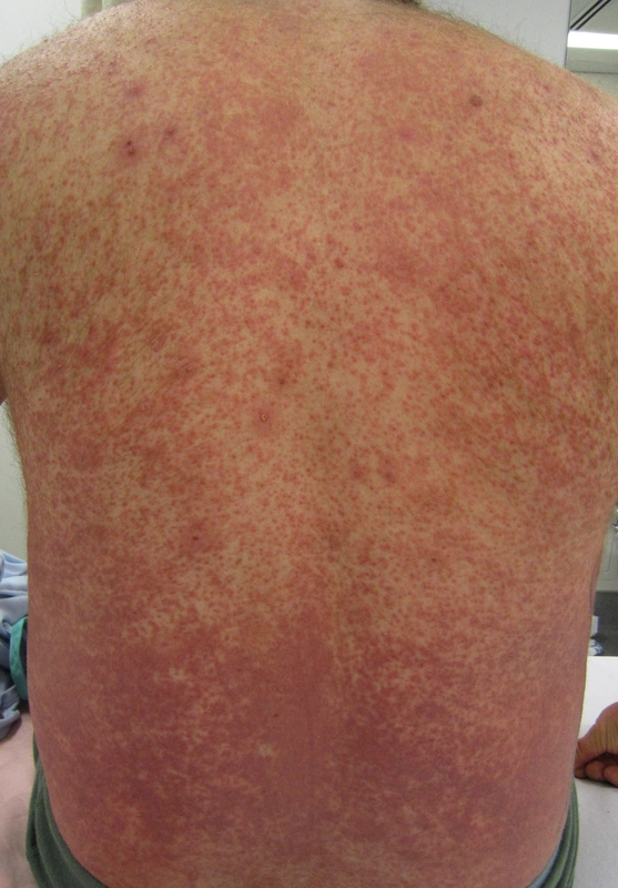 Blickdiagnose-Quiz Fall 38: klinisches Bild – welche Diagnose?