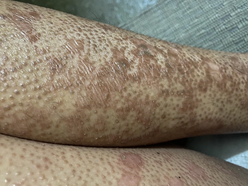 Blickdiagnose-Quiz Fall 56: klinisches Bild – welche Diagnose?