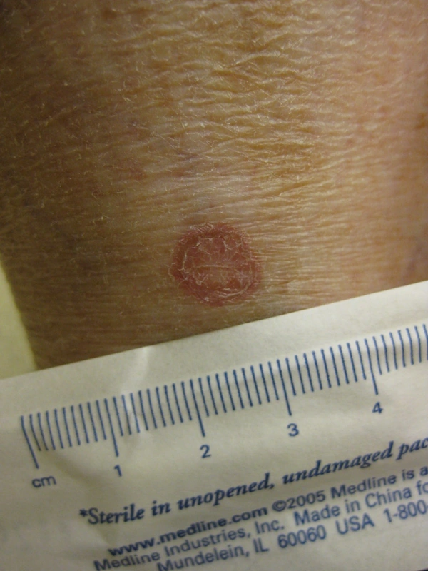 Spot-diagnosis quiz case 32: clinical image – which diagnosis?