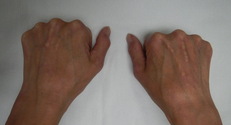 Blickdiagnose-Quiz Fall 48: klinisches Bild – welche Diagnose?