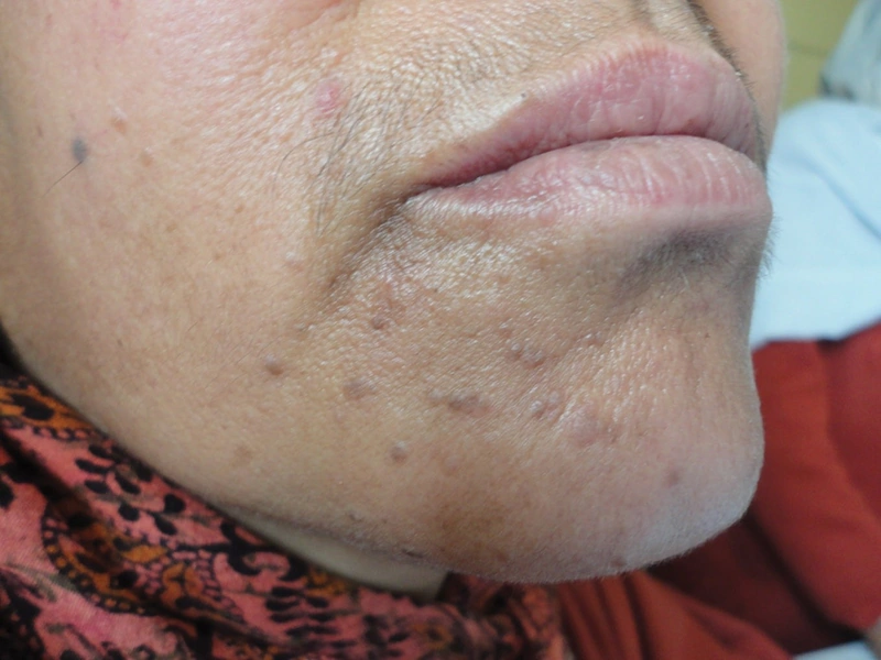 Blickdiagnose-Quiz Fall 44: klinisches Bild – welche Diagnose?