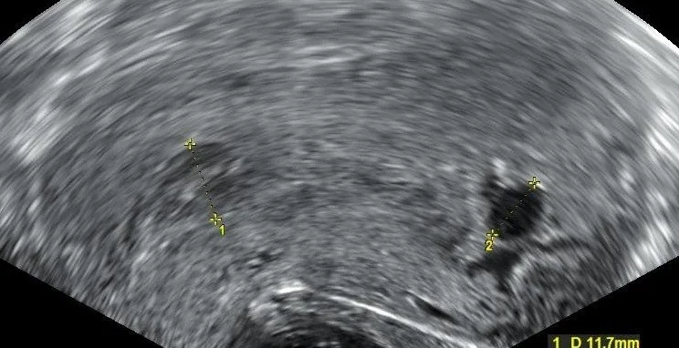 Abort (Fehlgeburt) – Sonographie: Unvollständiger Abort: heterogenes, verdicktes Cavum mit Schwangerschaftsresten bis in den Zervikalkanal