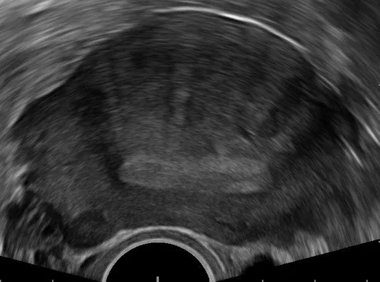 Adenomyose (Adenomyosis uteri) – Sonographie: Transvaginalsonographie: lineare subendometriale Striae mit fächerförmigem Schattenmuster — Adenomyose