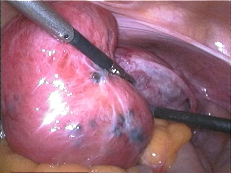 Adenomyose (Adenomyosis uteri) – Endoskopie & Makro: Laparoskopie-Situs: dunkle Endometrioseherde auf der Uteruswand (Adenomyosis uteri)