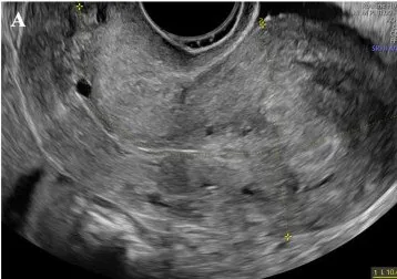 Adenomyose (Adenomyosis uteri) – Sonographie: Transvaginalsonographie: Myometriumzyste in einem globulär aufgetriebenen Uterus — MUSA-Kriterium der Adenomyose
