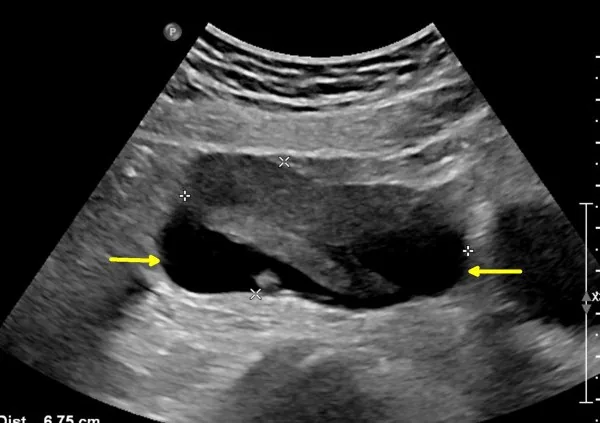 Pelvic inflammatory disease (PID) – Colposcopy: Diffusely reddened, inflamed cervix in cervicitis — the typical finding of a chlamydial infection of the endocervix
