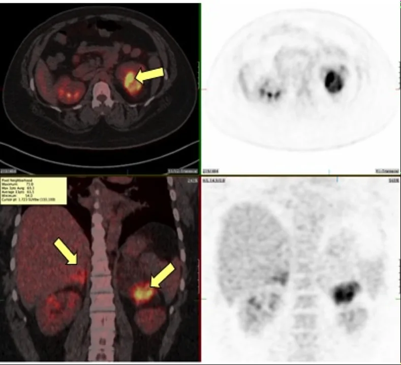Congenital adrenal hyperplasia (CAH) – Mammography/MRI: FDG PET/CT (axial and coronal): enlarged adrenal glands with masses (arrows) in congenital adrenal hyperplasia due to 21-hydroxylase deficiency, histologically myelolipoma