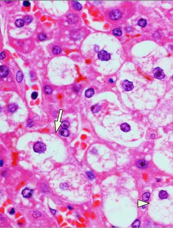 Akute Schwangerschaftsfettleber – Histologie & Zytologie: Histologie (HE): mikrovesikuläre Verfettung mit schaumigen Hepatozyten (Pfeile) bei akuter Schwangerschaftsfettleber