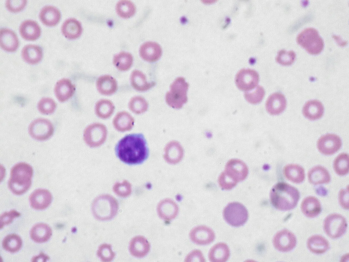 Anaemia in pregnancy – Histology & cytology: Microscopy (blood smear): hypochromic microcytic red cells with enlarged central pallor in iron deficiency anaemia – lymphocyte for size comparison