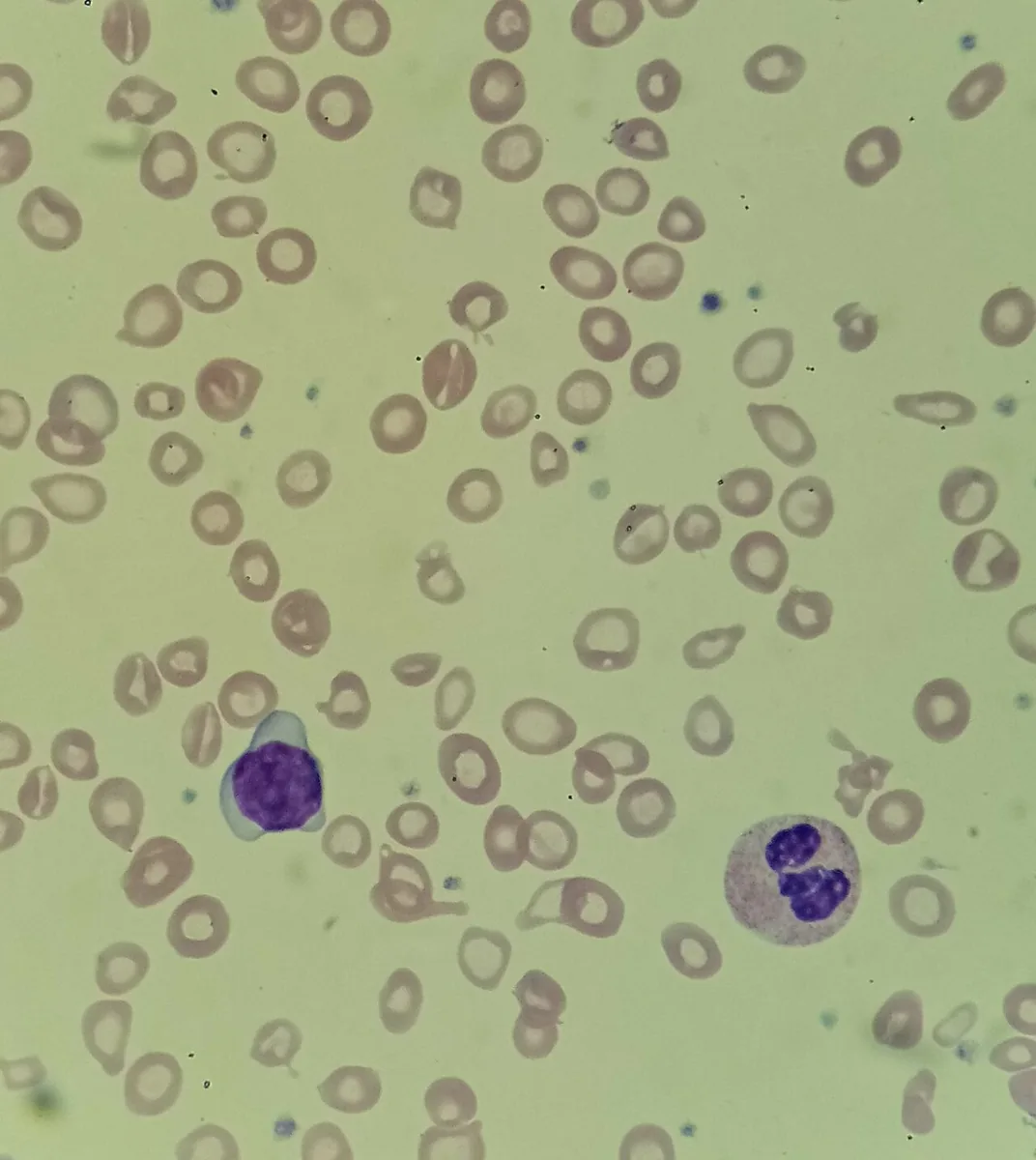 Anaemia in pregnancy – Histology & cytology: Microscopy (blood smear): severe iron deficiency anaemia with microcytosis, hypochromia, anisocytosis and poikilocytosis (including pencil cells)