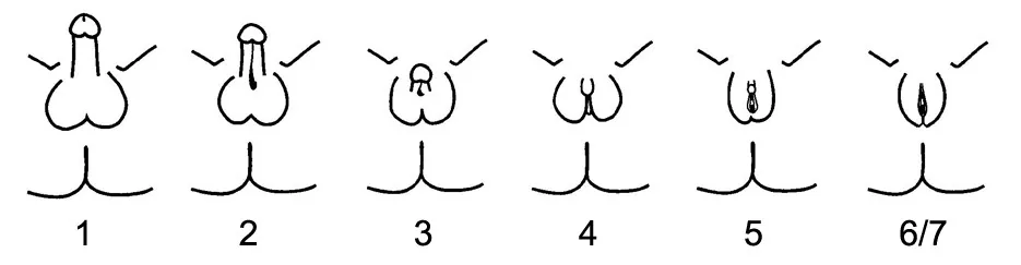 Androgenresistenz (komplette Androgeninsensitivität) – Schema: Schema: Quigley-Skala der Androgenresistenz – Grad 1 (minimal) bis 6/7 (komplett, CAIS) mit zunehmend weiblichem äußeren Genitale; bei CAIS (Grad 7) unauffällig weibliches Genitale ohne …