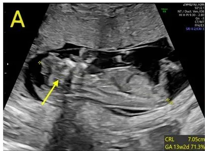 Anencephaly – Ultrasound: Anencephaly (acrania)