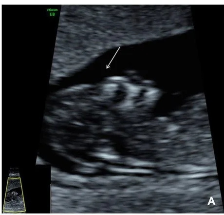 Anencephaly – Ultrasound: Anencephaly (acrania)