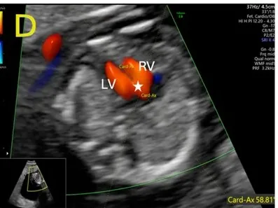 Congenital heart defects (prenatal) – Clinical