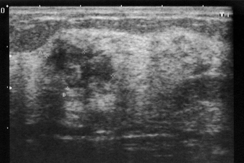 B3-Läsionen der Brust – Sonographie: Mammasonographie: echoarmer, unscharf begrenzter Herd mit dorsalem Schallschatten