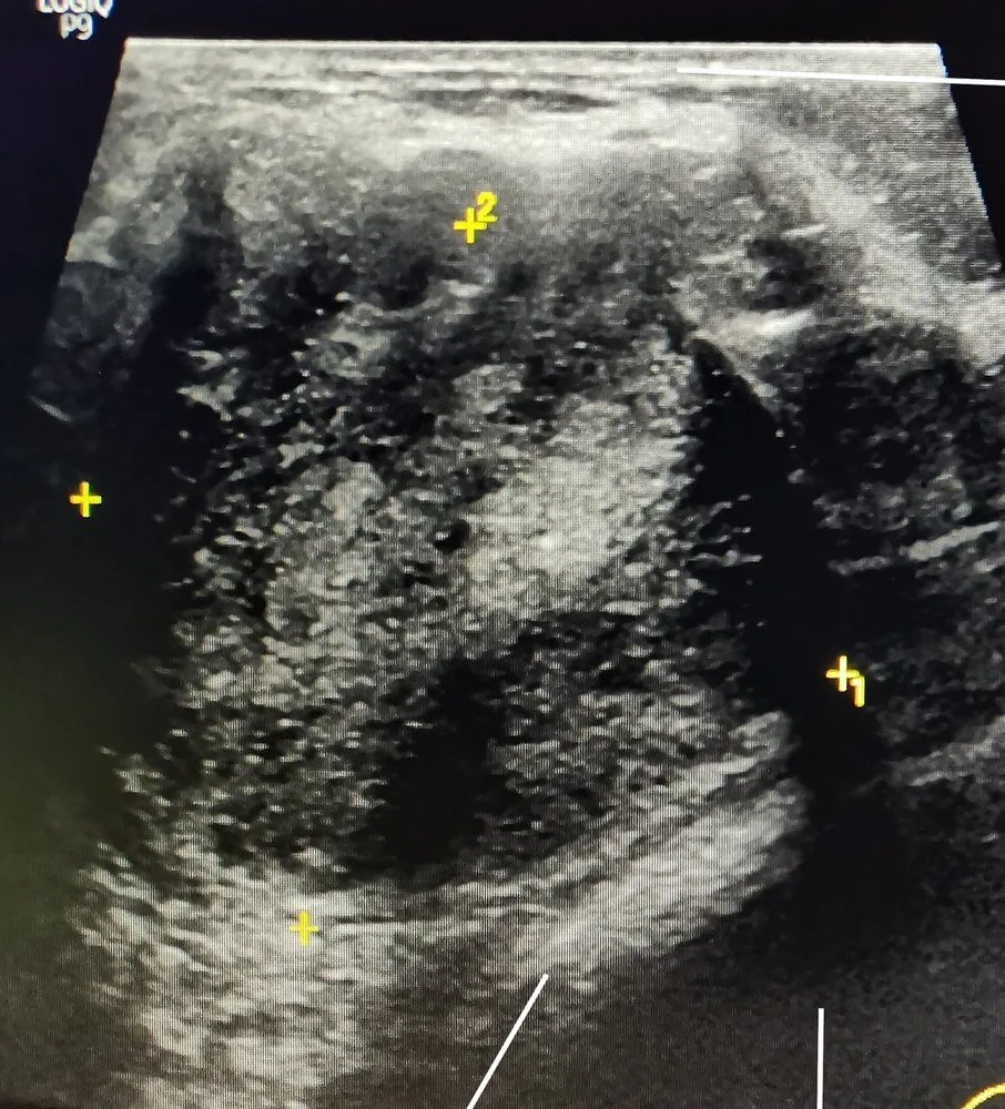 B3-Läsionen der Brust – Sonographie: Mammasonographie: großer, heterogener solider Herd — histologisch Phyllodestumor