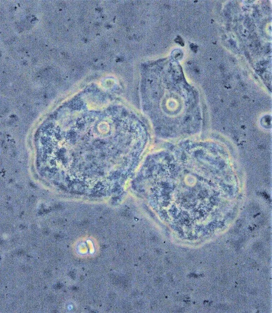 Bacterial vaginosis – Histology & cytology: Clue cells in phase contrast: granulated cytoplasm and roughened cell borders