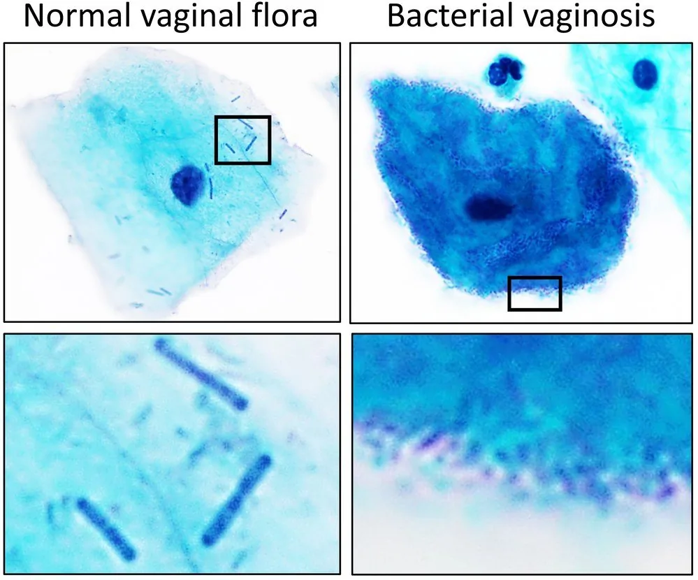 Bacterial vaginosis – Diagram: Comparison chart: on the left, a squamous epithelial cell with rod-shaped normal flora; on the right, a cell densely covered with bacteria in bacterial vaginosis