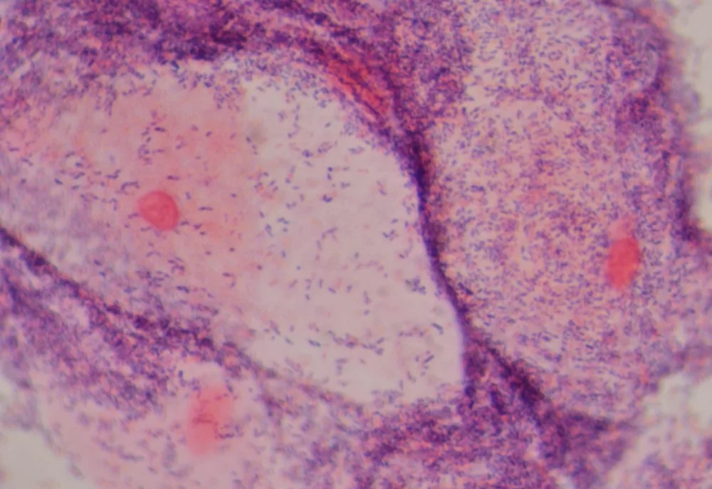 Bacterial vaginosis – Endoscopy & gross