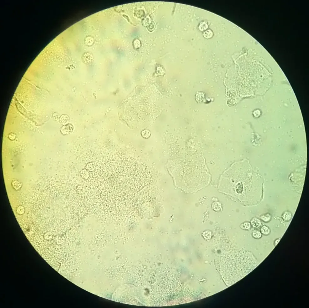 Bacterial vaginosis – Endoscopy & gross