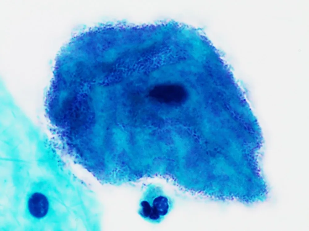 Bacterial vaginosis – Histology & cytology