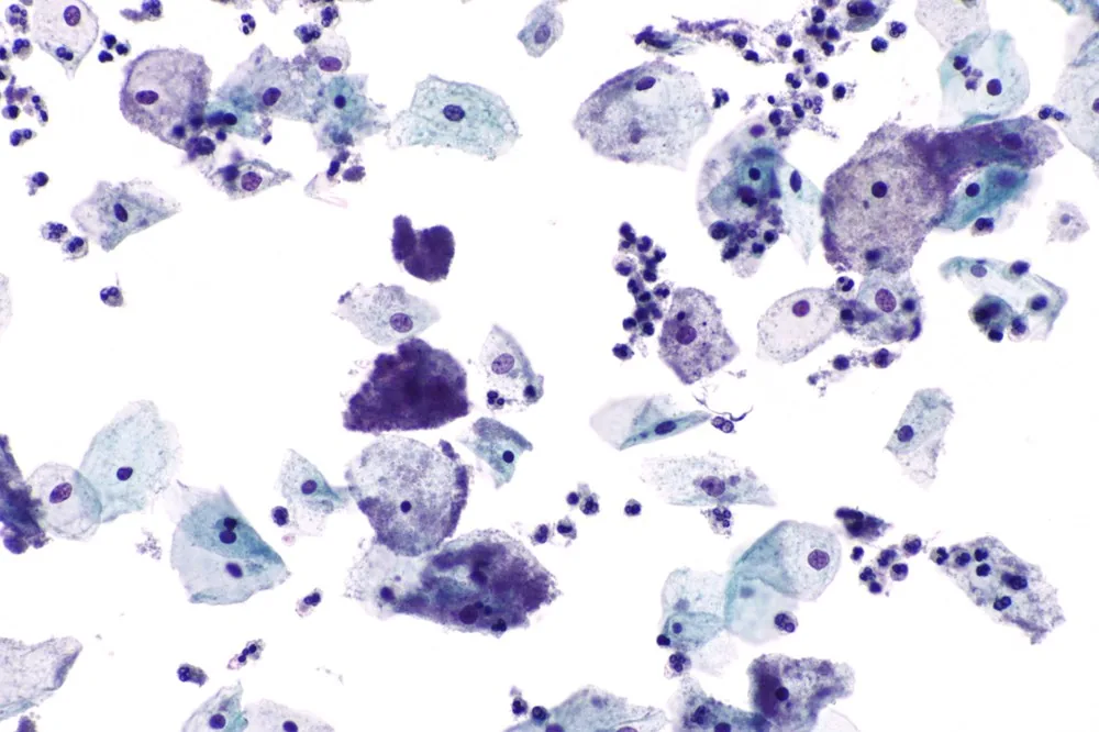 Bacterial vaginosis – Histology & cytology