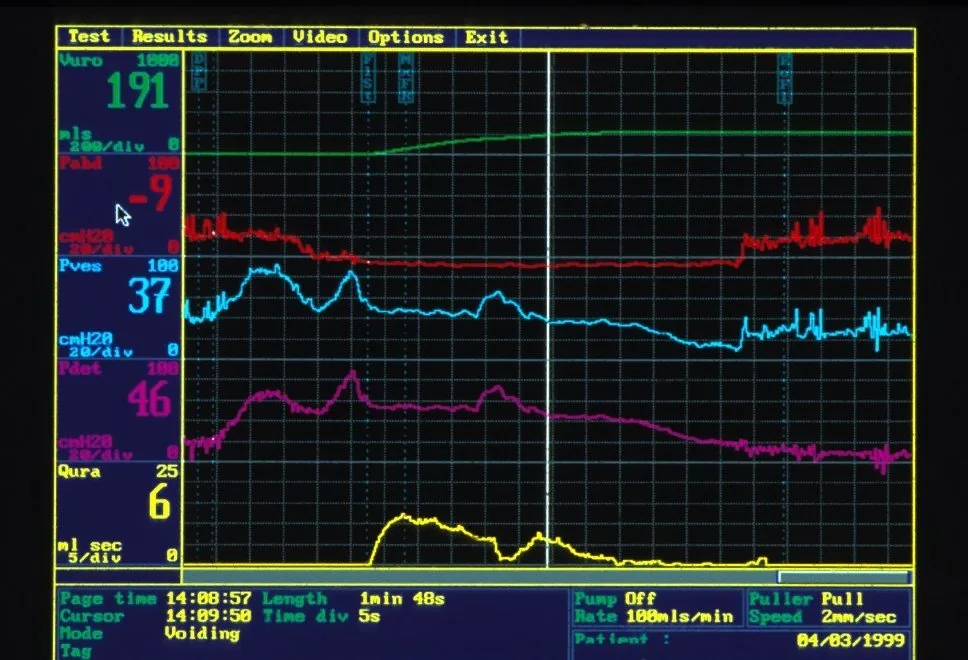 Stress urinary incontinence – Clinical: Urodynamic tracing showing the channels for bladder pressure (Pves), abdominal pressure (Pabd), detrusor pressure (Pdet), and urinary flow (Qura)
