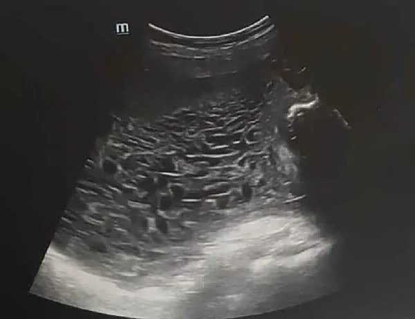Blasenmole (Trophoblasterkrankung) – Sonographie: Schneegestöber: honigwabenartiges Binnenmuster der molaren Plazenta im Ultraschall (Foto: Abou Chakra R, Arab W, El Kassis N, Nassar M, El Ghoul K, Atallah D. (Case reports in obstetrics …
