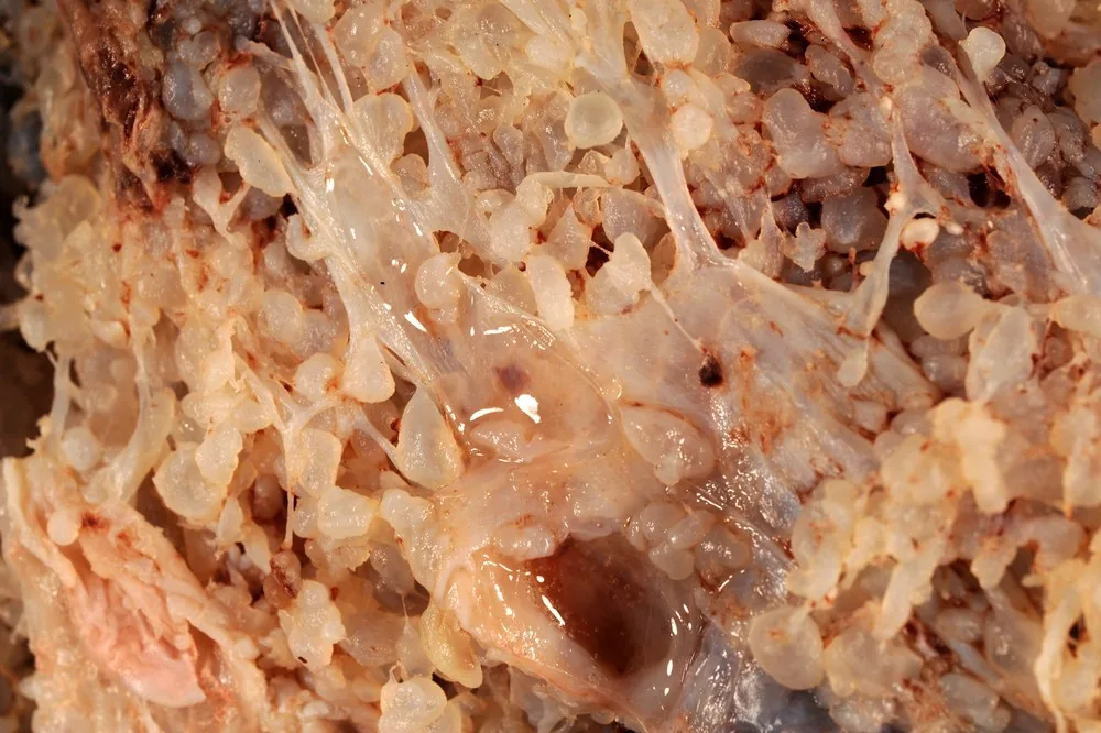 Blasenmole (Trophoblasterkrankung) – Endoskopie & Makro: Blasenmole makroskopisch: Bläschentrauben mit Zottenstielen