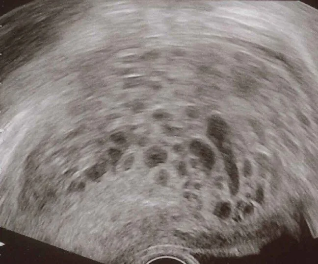 Blasenmole (Trophoblasterkrankung) – Sonographie: Transvaginalsonogramm einer Blasenmole: traubenartiges, vesikuläres Binnenmuster im Cavum