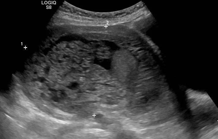 Blasenmole (Trophoblasterkrankung) – Sonographie: Blasenmole, transabdominal: heterogene vesikuläre Raumforderung im Uterus