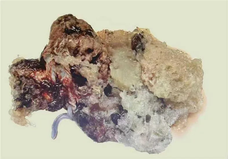 Blasenmole (Trophoblasterkrankung) – Endoskopie & Makro: makroskopisches Präparat einer molaren Plazenta mit hydropischen Zotten