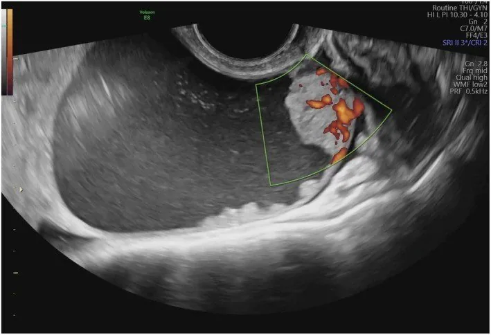 Borderline-Tumor des Ovars – Sonographie: Transvaginalsonographie: unilokulär-solide Zyste mit papillärer Projektion, Color Score 3 — histologisch seromuzinöser Borderline-Tumor