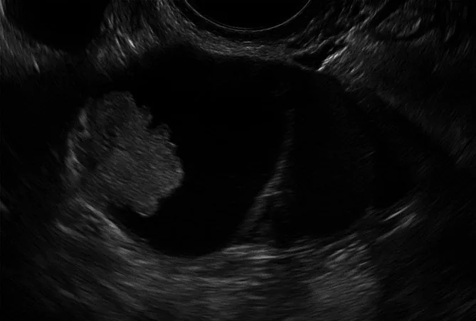 Borderline-Tumor des Ovars – Sonographie: Transvaginalsonographie: unilokuläre Zyste mit großer solider papillärer Projektion (daneben ein Endometriom)