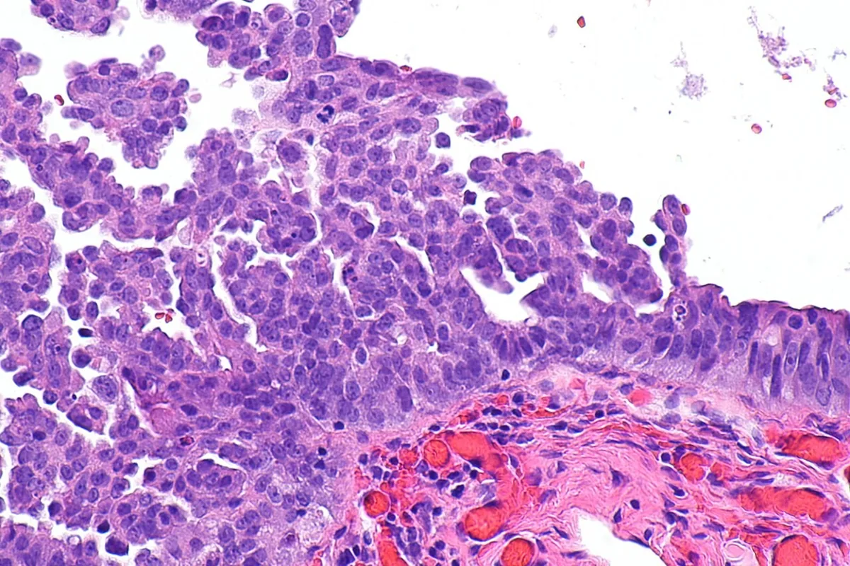 Hereditary breast and ovarian cancer syndrome (BRCA) – Histology & cytology: Histology (H&E): serous tubal intraepithelial carcinoma (STIC) – stratified, markedly atypical tubal epithelium with nuclear enlargement and loss of polarity, residual normal epithelium …