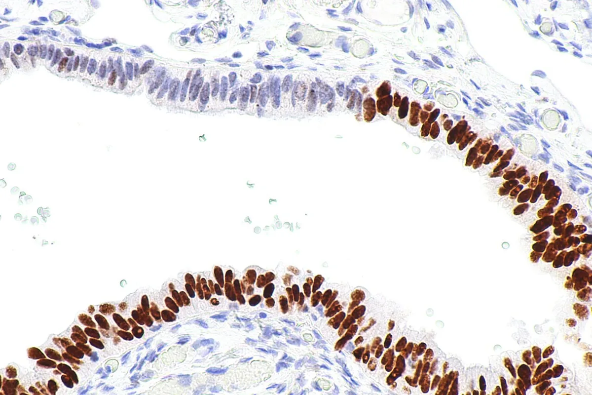 Hereditary breast and ovarian cancer syndrome (BRCA) – Histology & cytology: p53 immunohistochemistry: STIC with strong diffuse nuclear p53 staining (mutant-type pattern), sharply demarcated from unremarkable tubal epithelium with weak wild-type staining (upper left)