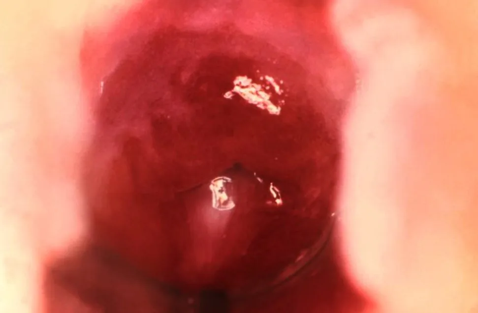 Chlamydia infection – Colposcopy: Diffusely reddened, inflamed cervix in cervicitis — the typical finding of a chlamydial infection of the endocervix