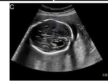 Zytomegalie (CMV) in der Schwangerschaft – Sonographie: Ventrikulomegalie in der 23. SSW: Seitenventrikel 1,01 cm bei konnataler Zytomegalie (Foto: Sun J, Gao W, Tan H. (Frontiers in pediatrics, 2026), Open Access, CC BY 4.0)